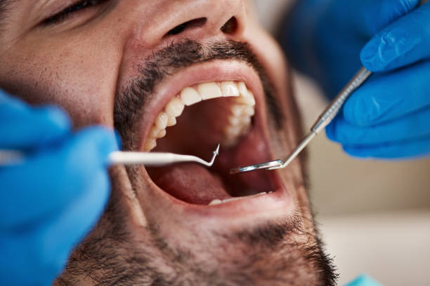 Best Urgent Care for Lost Fillings or Crowns in Richmond West, FL